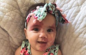 Mom paints face to look like daughter’s heart-shaped port wine birthmark